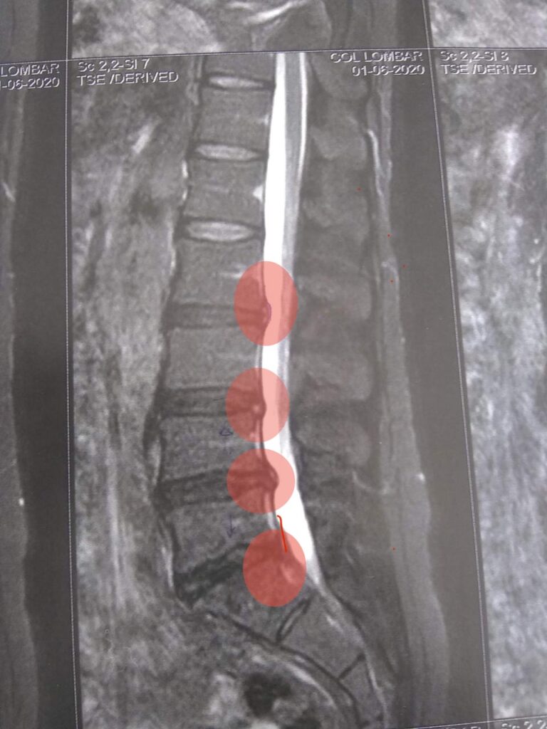 MRI of a spine with 4 herniated discs